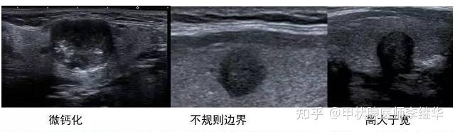 甲状腺结节钙化有多种,粗大、微小钙化、砂粒样钙化到底哪种钙化恶性几率大? - 知乎