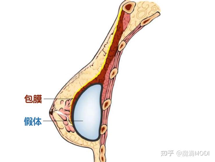 魔滴學堂絲面波假體隆胸手感如何會不會移位