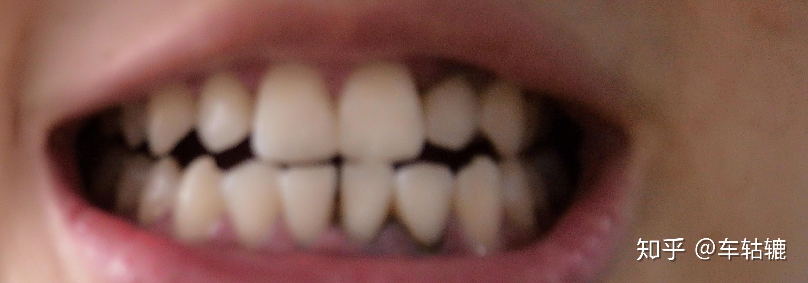 치통 일러스트, 치과, 보호 이가, 이 PNG 일러스트 및 PSD 이미지 무료 다운로드 - Pngtree