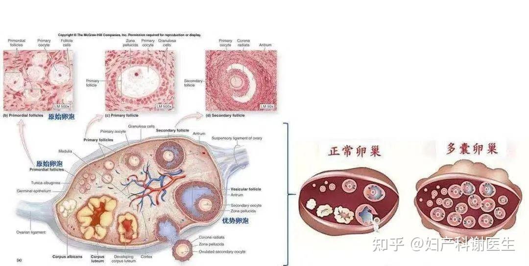 多囊卵巢綜合徵pcos與子宮內膜病變的關係