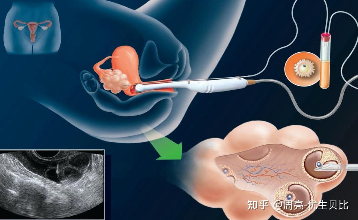 试管婴儿取卵对身体有伤害吗？