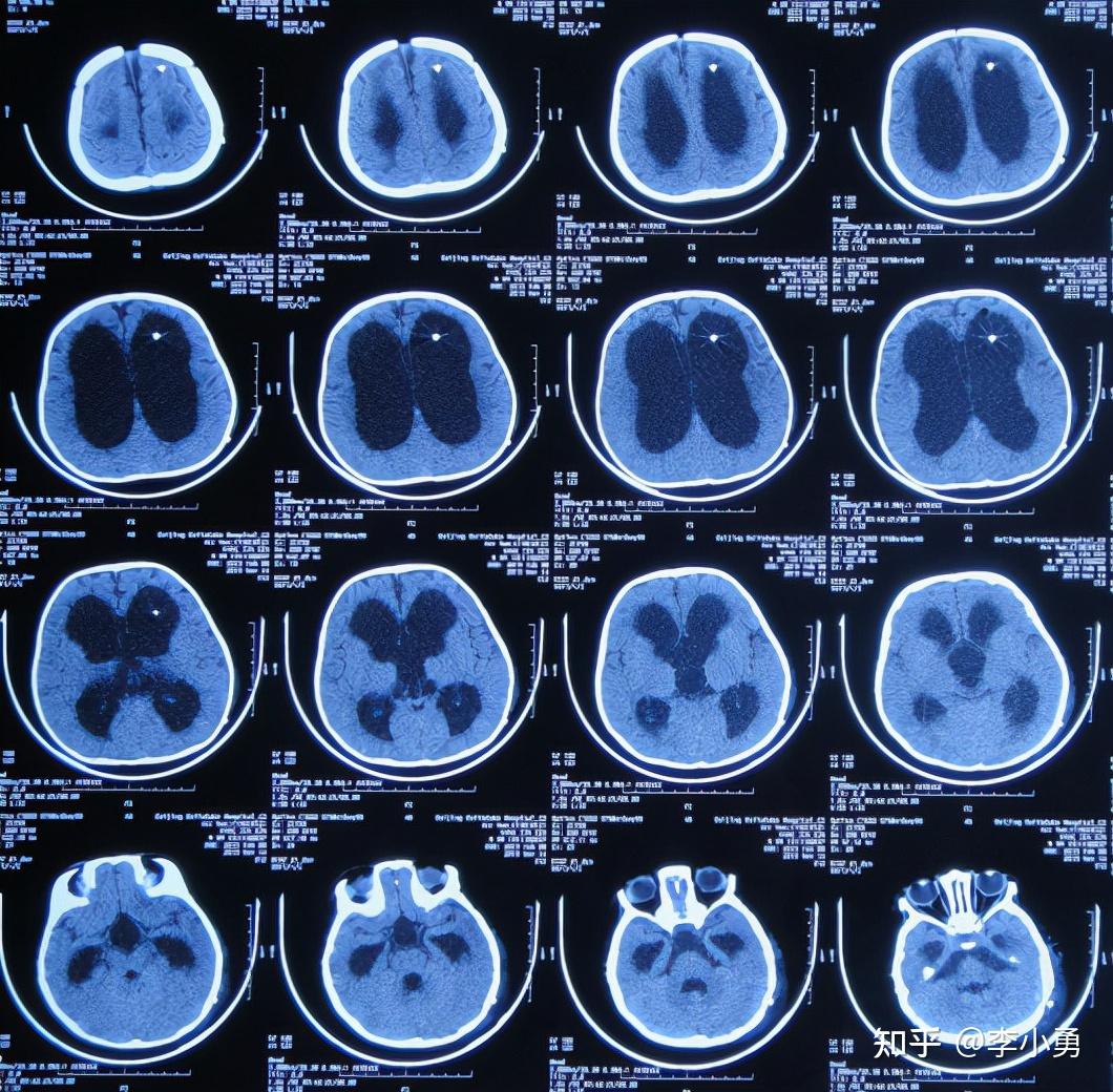 9月大婴儿大头脑积水后直接采用李小勇氏预防分流感染和堵管并发症并