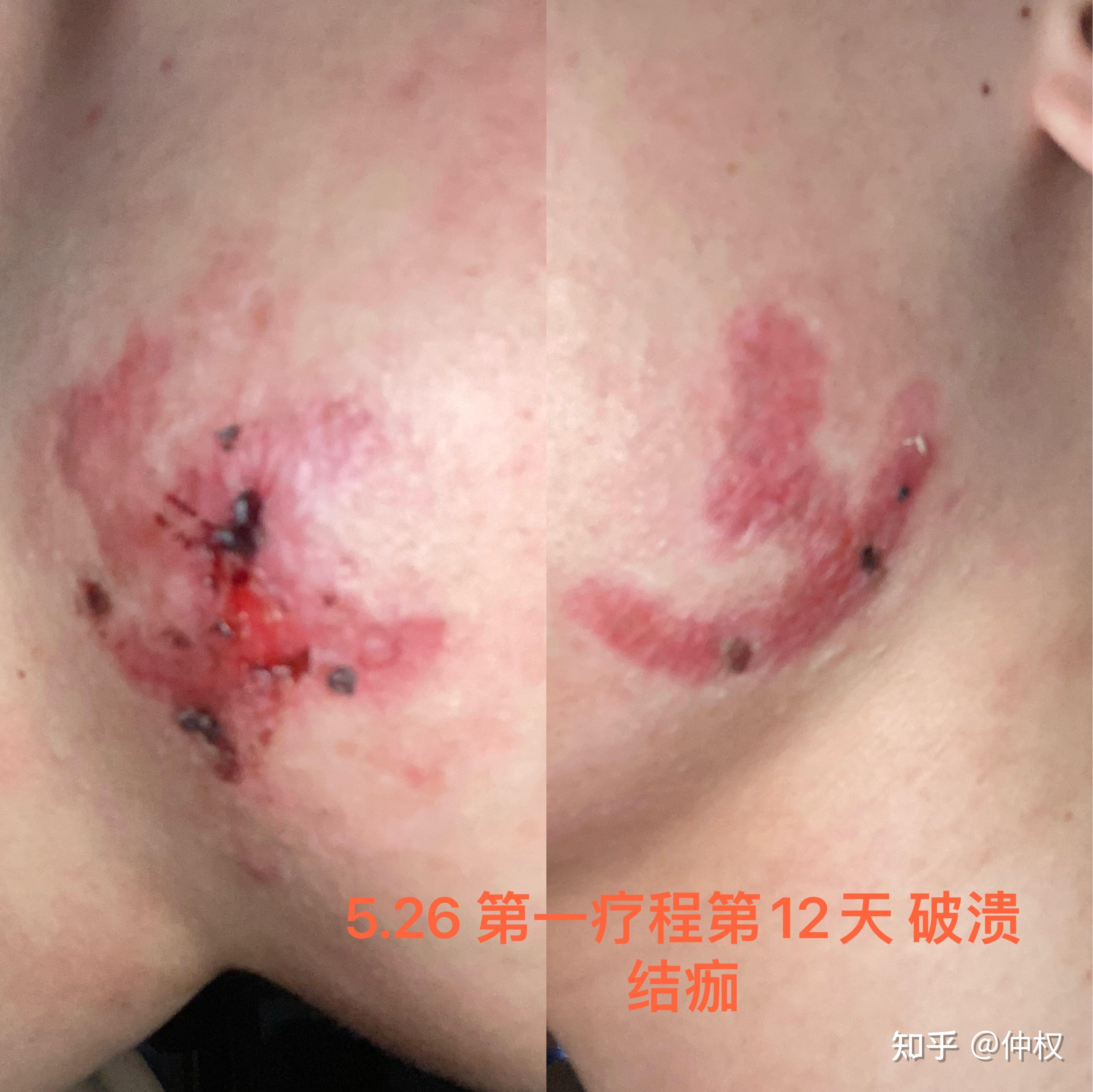 瘢痕疙瘩治疗 - 知乎