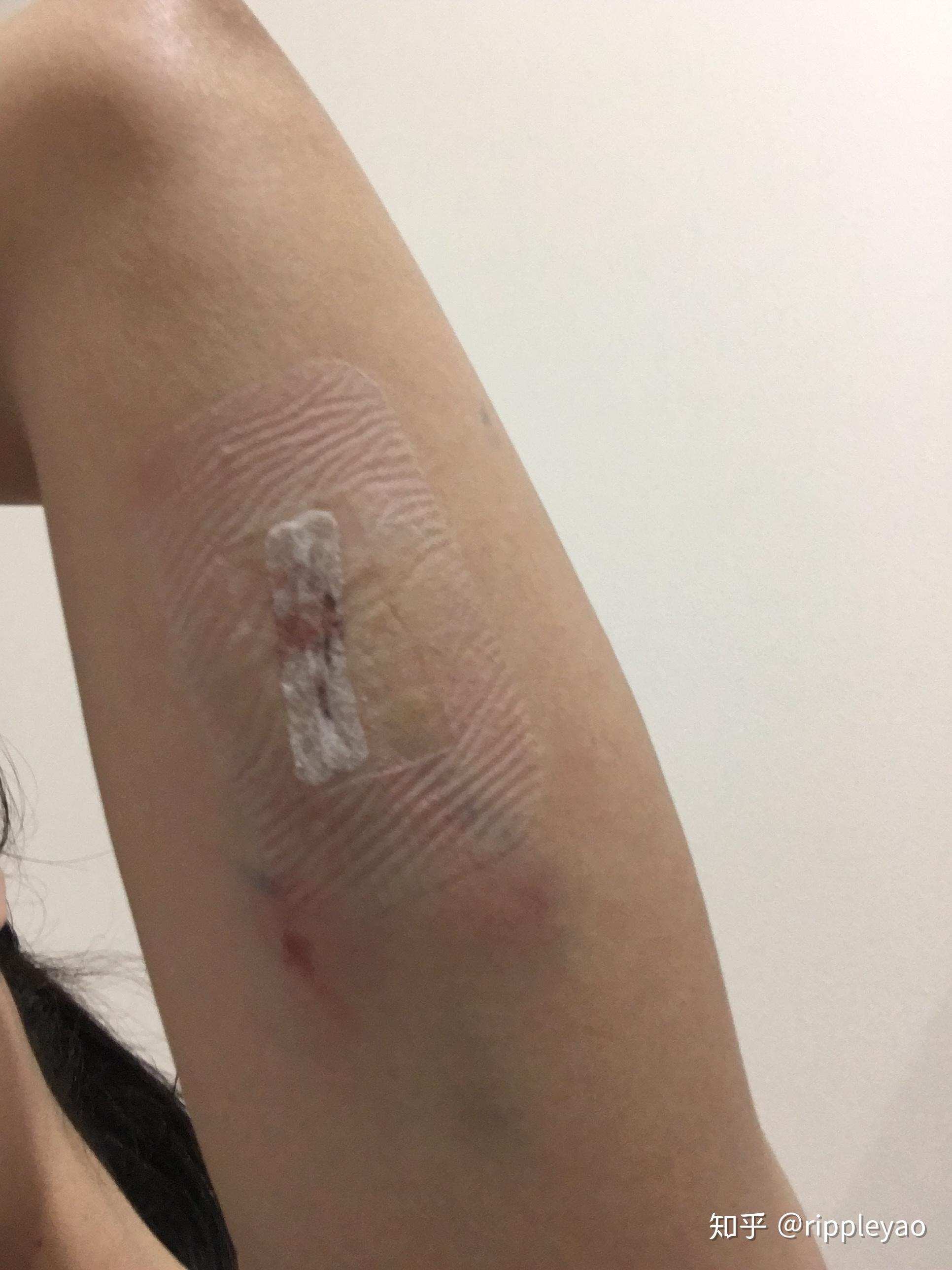 有小伙伴试过皮下埋植避孕法implant吗是怎么样的体验有怎样的不良