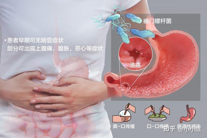 你胀气我溃疡他胃癌我们都有幽门螺杆菌