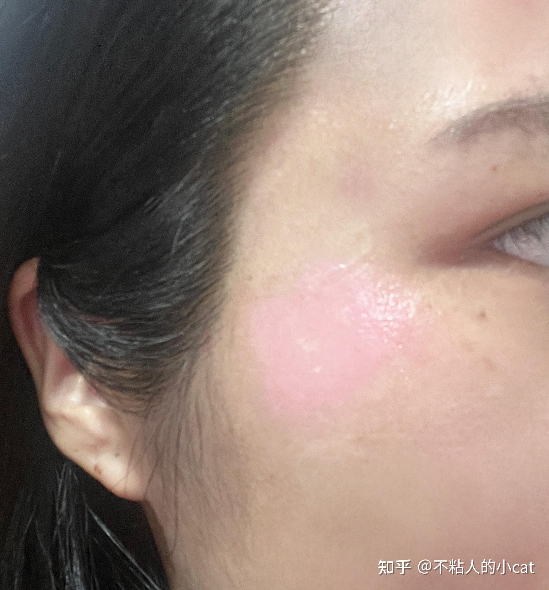 脸部擦伤愈合处理过程记录