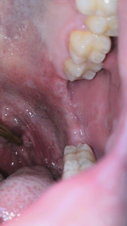 扁桃体结石是如何形成的 知乎