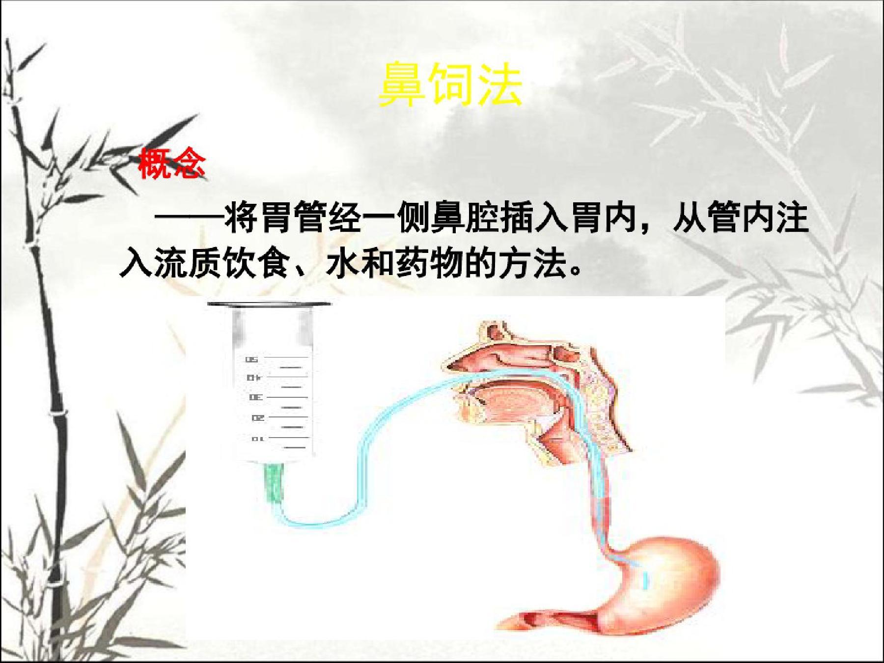 患者上消化道没有问题可以重复插管鼻饲