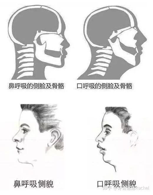 上颚高拱图片