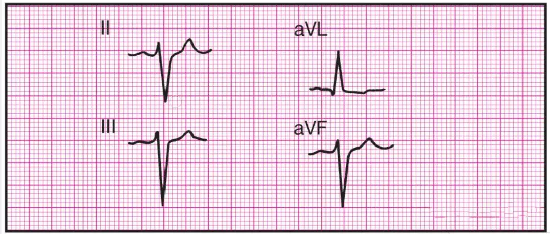 14種異常心電圖的波形特點建議收藏