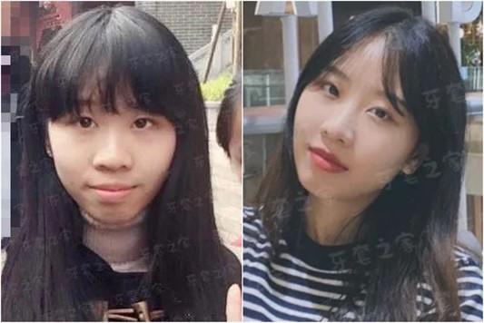 骨性凸嘴二次矫正关节有问题导致进行性张嘴困难下颌向左歪戴半年颌垫