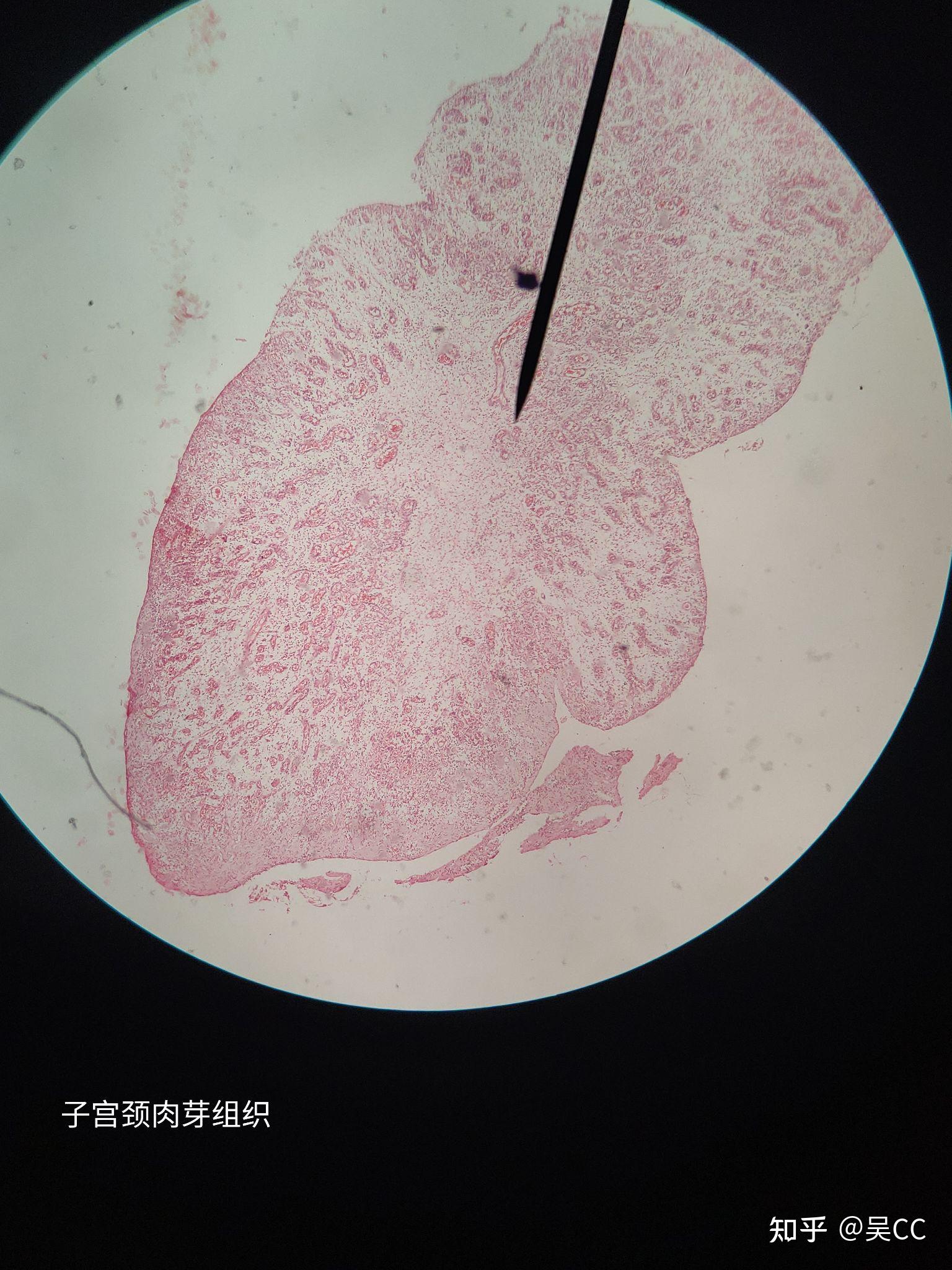 凝固性坏死图片干酪图片