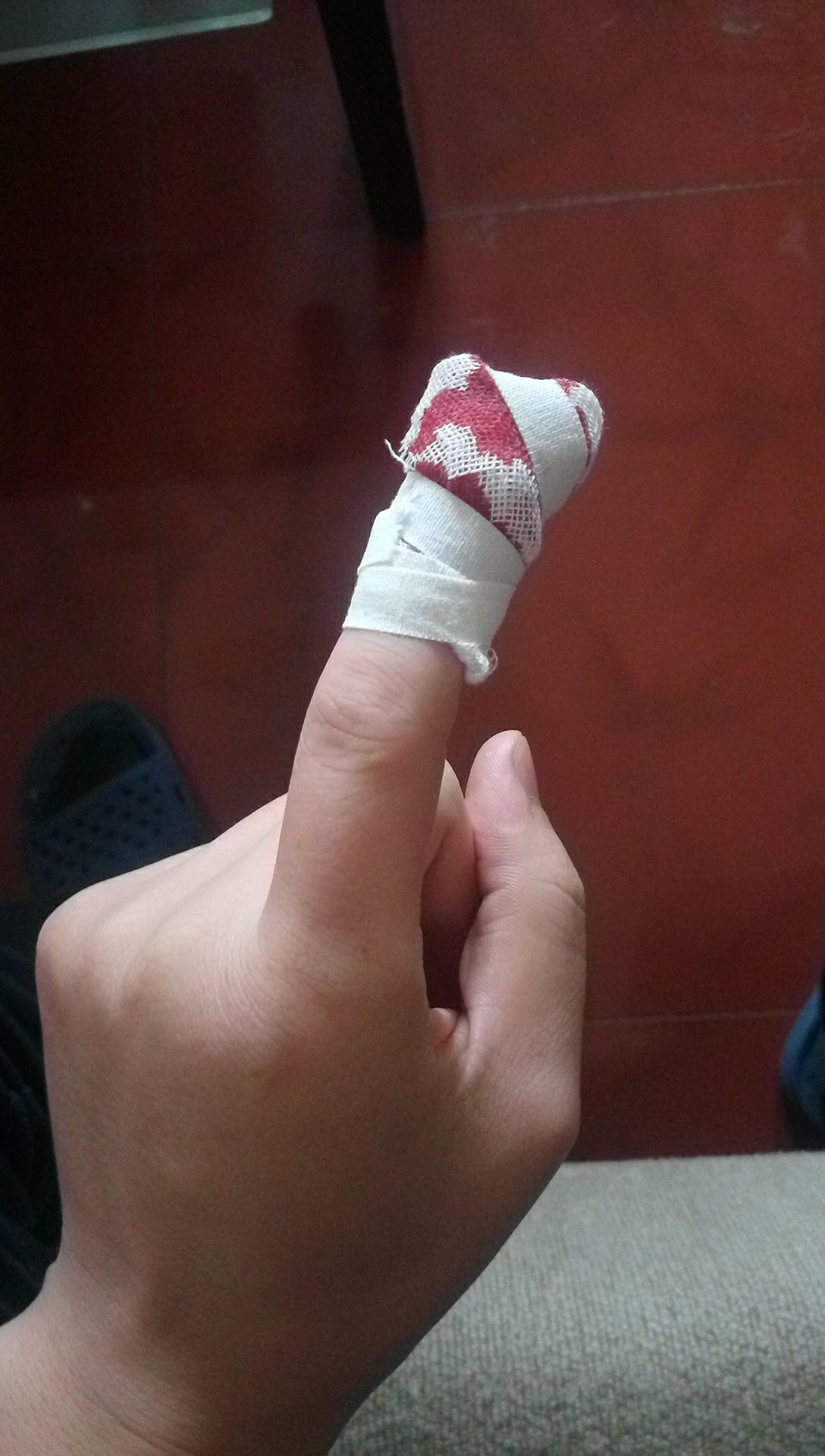 切菜的时候把手指甲切掉了一半血流不止,英国的医生只用温水冲了一下