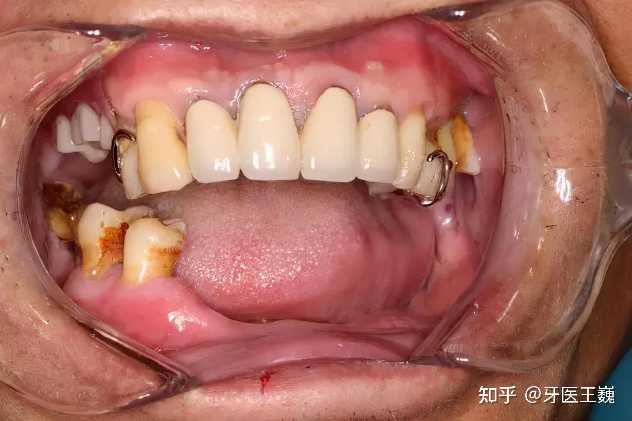 单颗活动义齿图片,单个动义齿,门牙动义齿图片(第2页)_大山谷图库