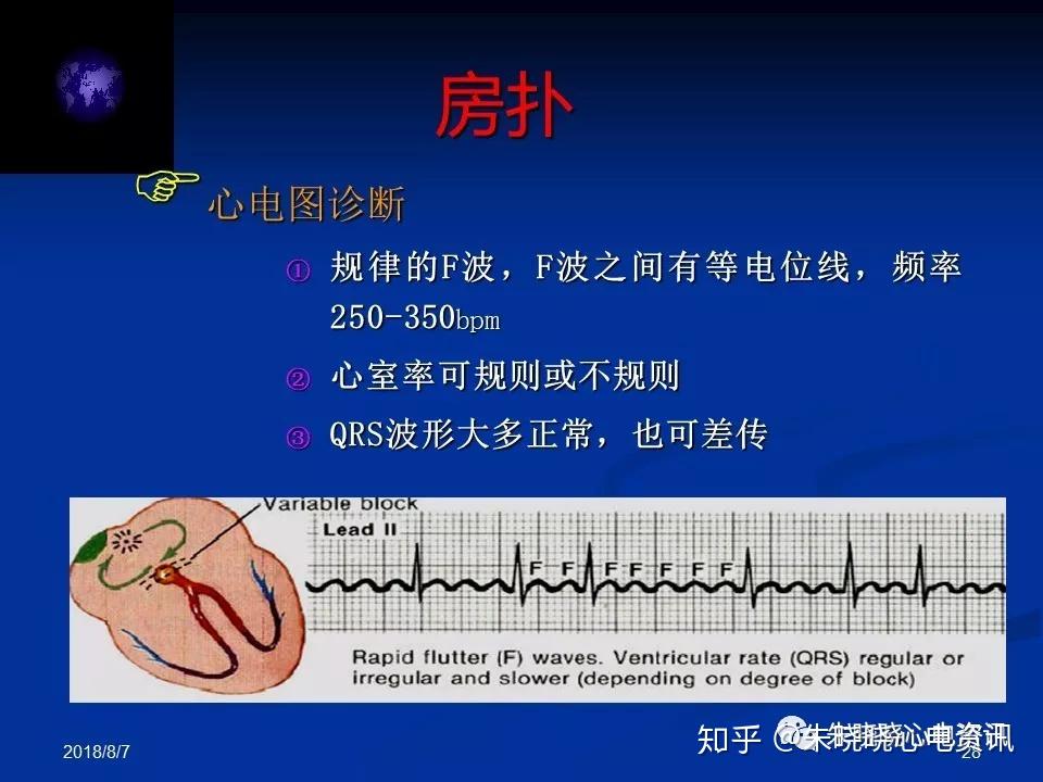 急診心電圖識別精要ppt