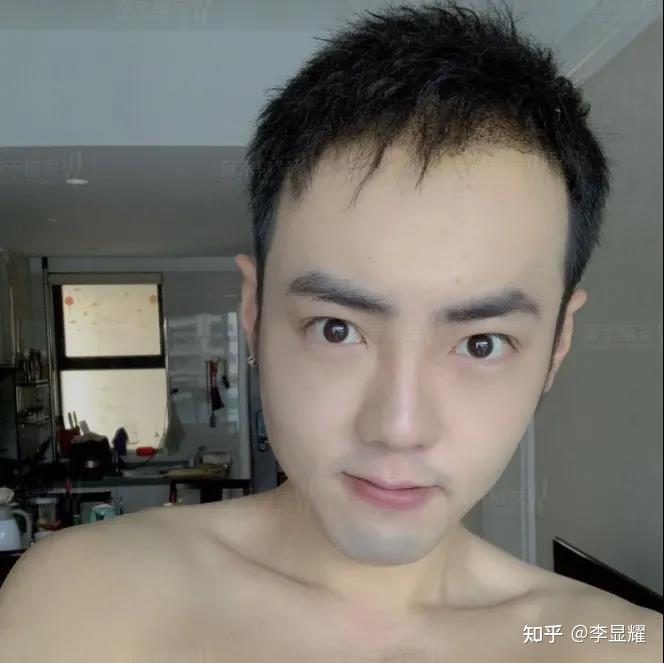 植发7天后的小泽,洗完头清理完血痂后小发茬看的很清爽:植发15天后的