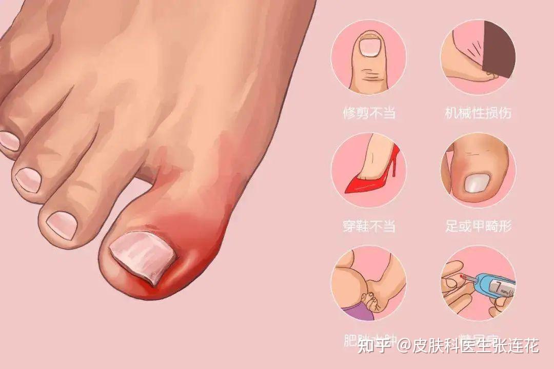 赣州治甲沟炎医院乱剪指甲当心引起甲沟炎