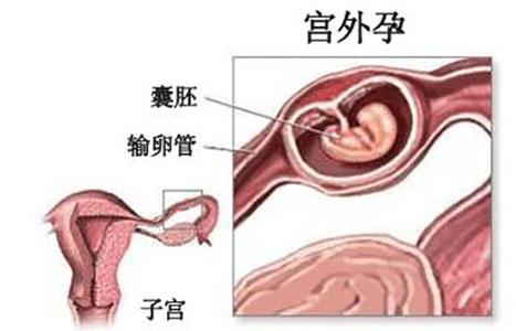 备孕千万注意 别把宫外孕误当月经 知乎