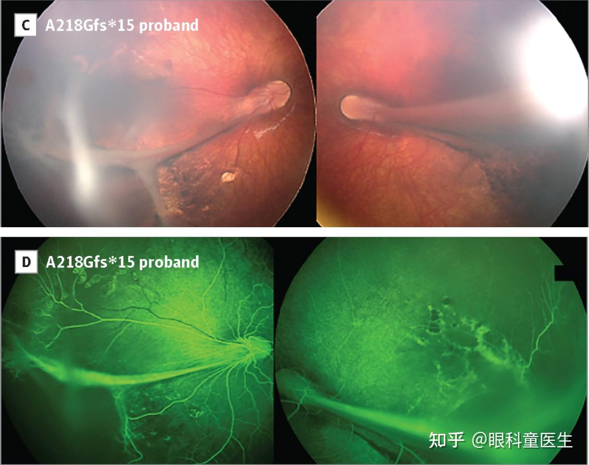 先天性视网膜异常4先天性视网膜皱襞
