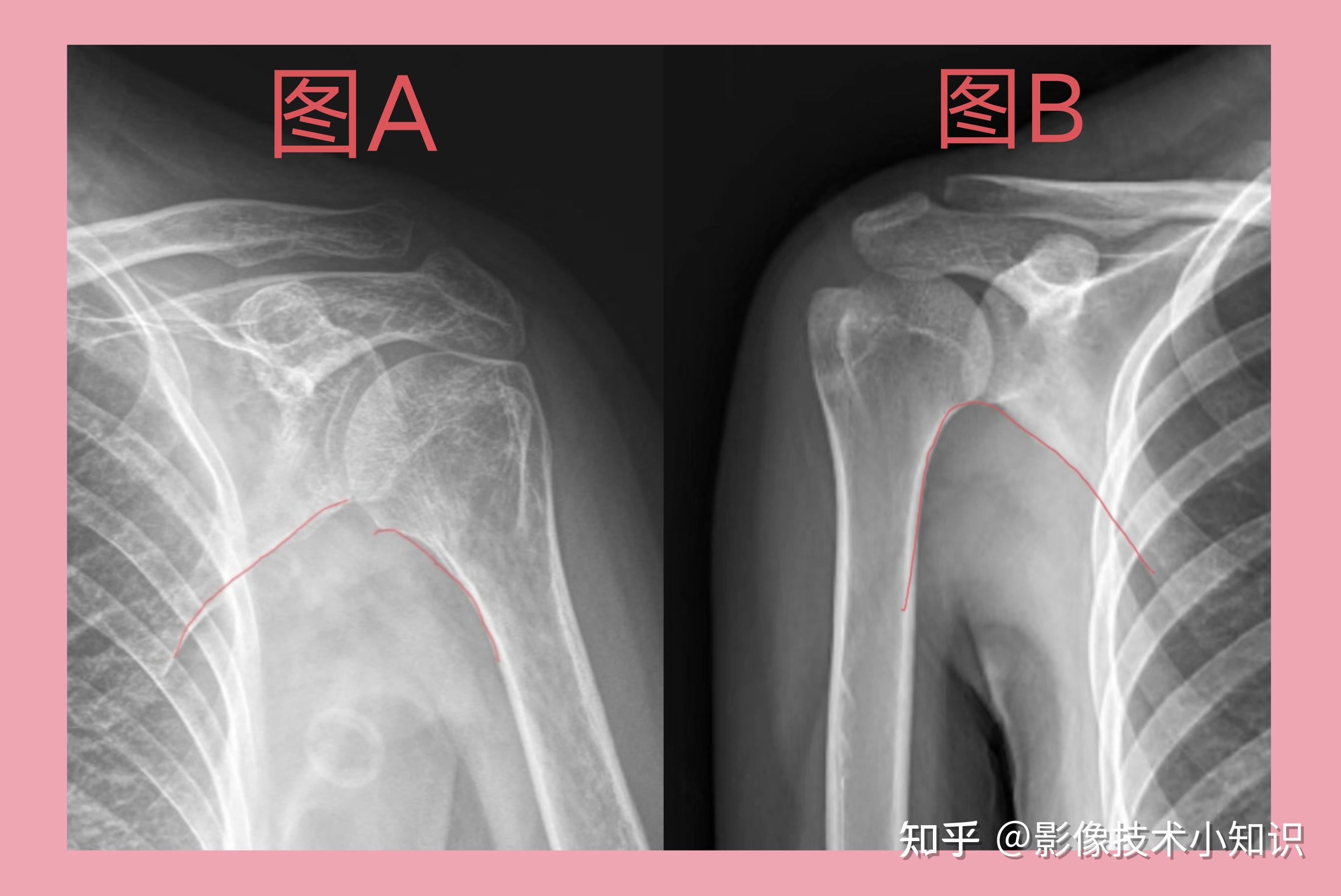 肩关节内收和外展对影像诊断的影响