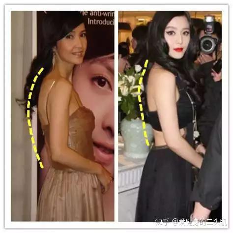 全网最硬核干货如何矫正你的驼背问题