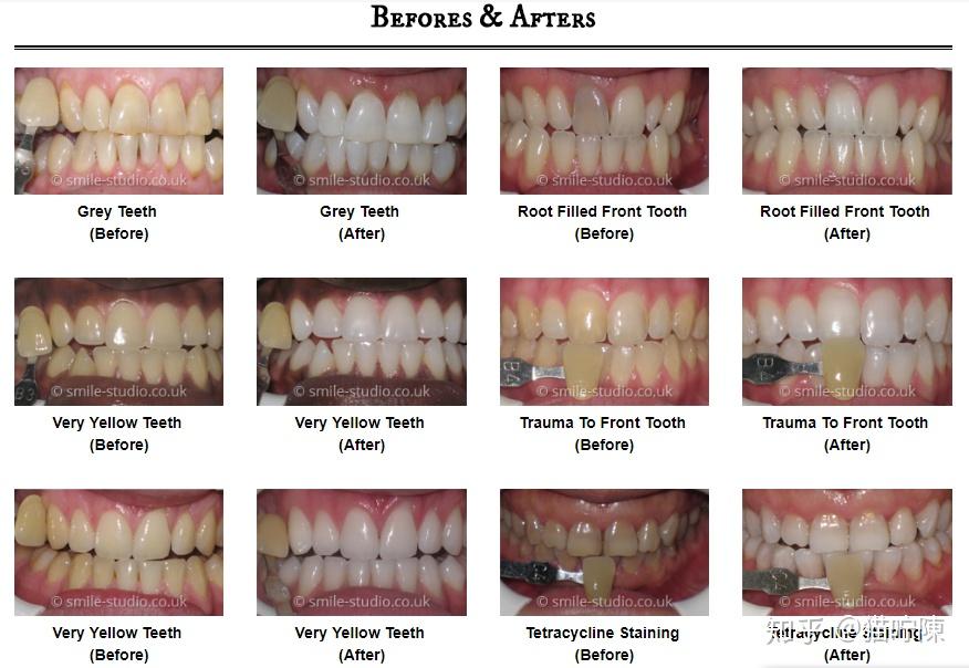 吐血总结牙黄怎么办关于牙齿美白也许这里就有你想要的所有答案