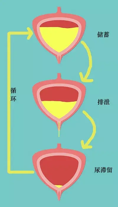 憋尿憋多了你的膀胱会爆炸