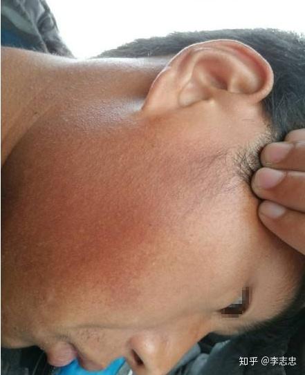 没想到你居然是这种皮肤 毛周角化症 知乎