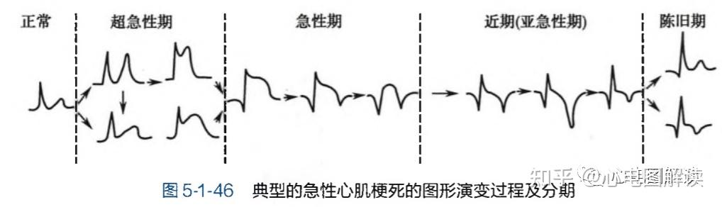 心梗的心电图表现图片