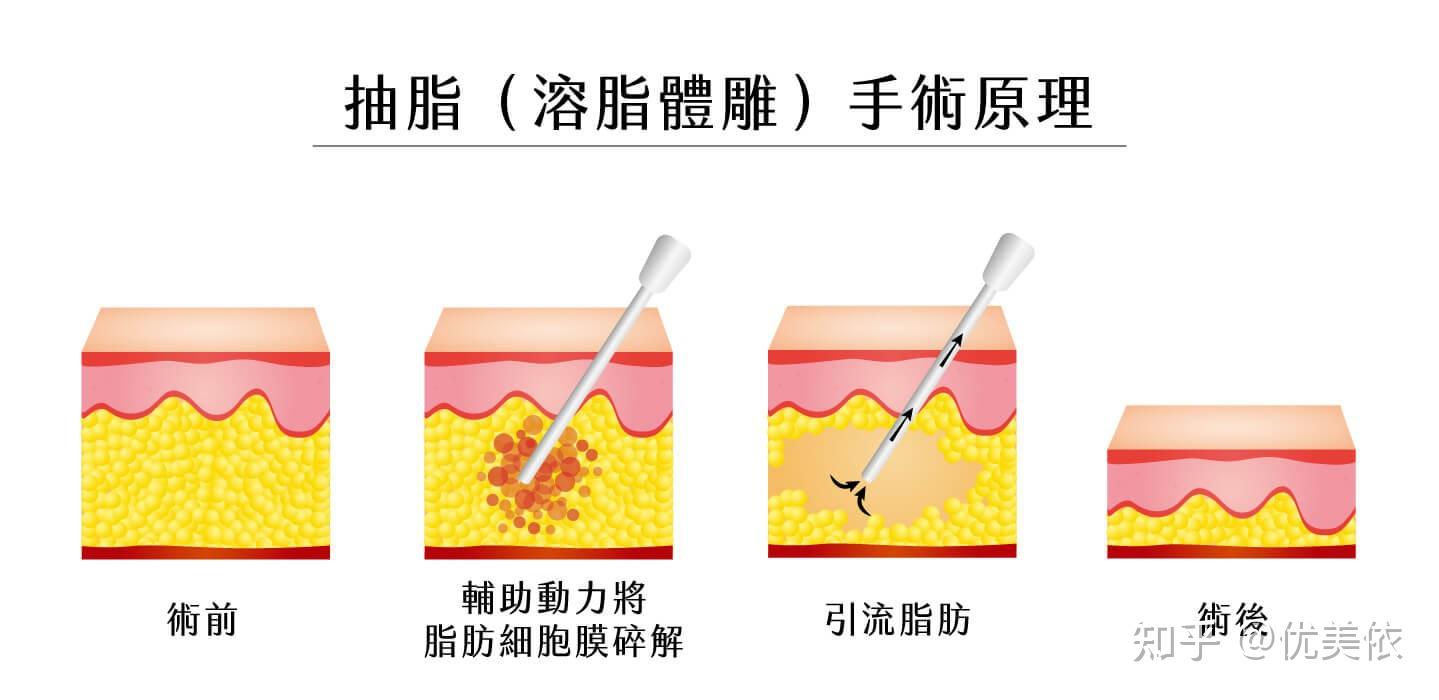 超声波吸脂图片