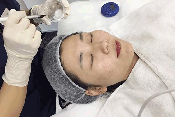 刷酸自己在家就能做了终于找到在家轻松去闭口的方法