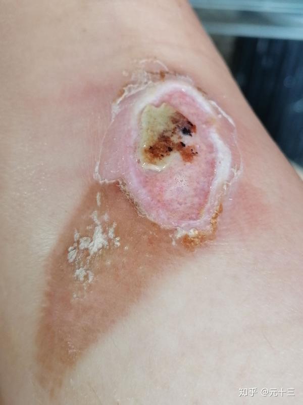 20岁烫伤严重除了手术还有救吗