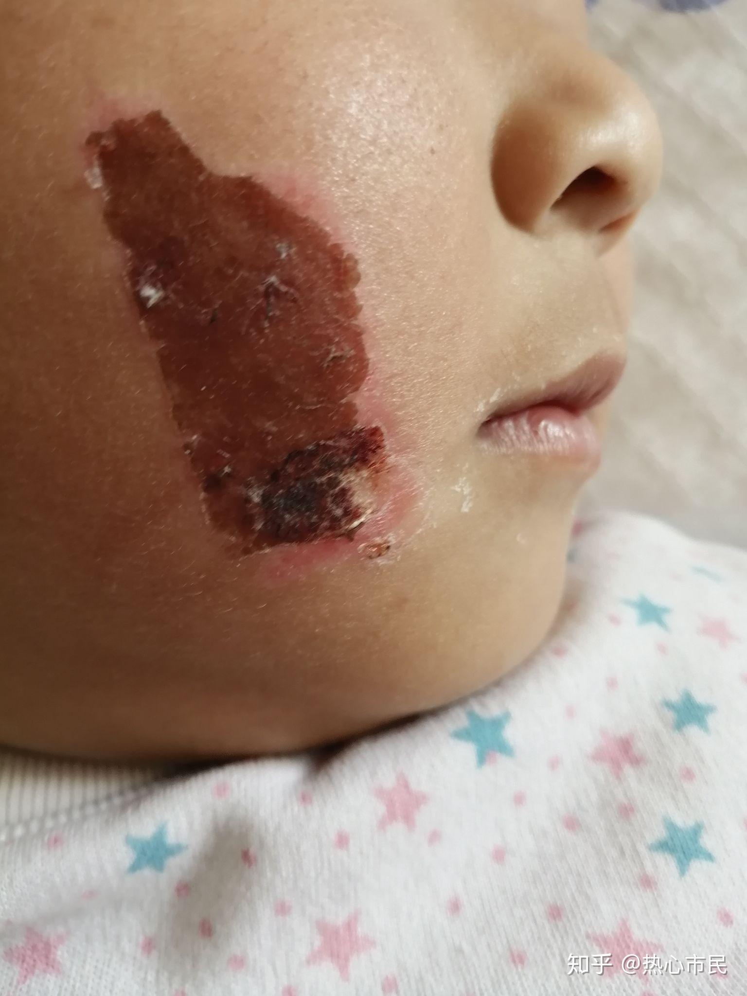 小孩脸部烧伤照片图片