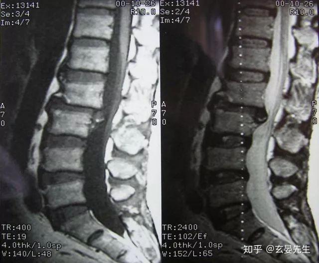 腰椎间盘突出症诊断与治疗 很详细！ 知乎