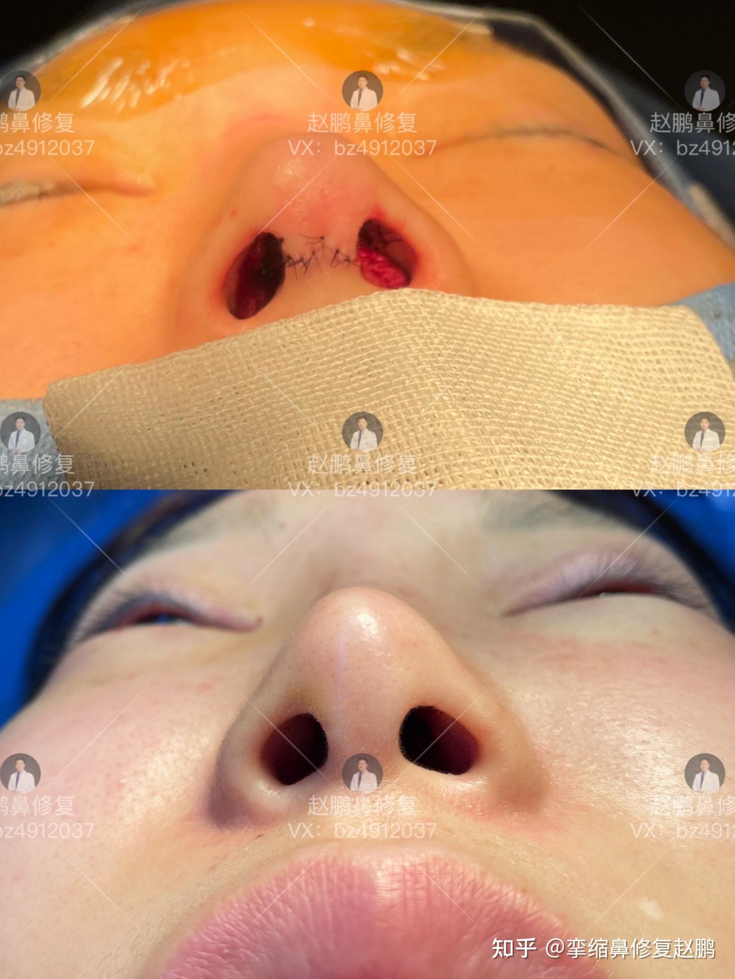 确实比膨体材料产生包膜挛缩概率要稍微高一些,在选择隆鼻材料的修复