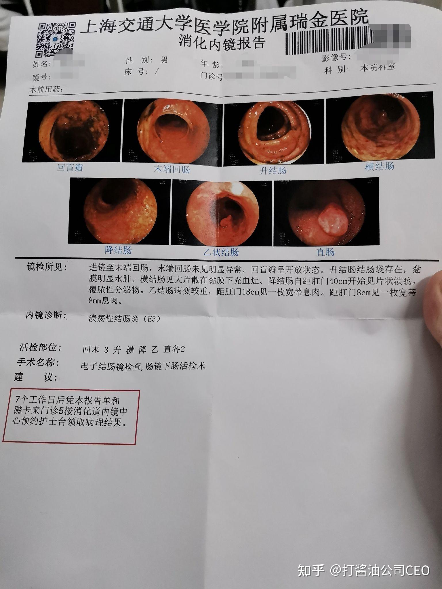 潰瘍性結腸炎的漫漫治療路程二