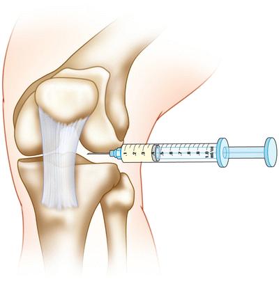 特别是关节腔和组织间隙内注射玻璃酸钠