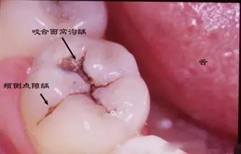 后牙上的黑线是蛀牙吗 该如何预防 知乎