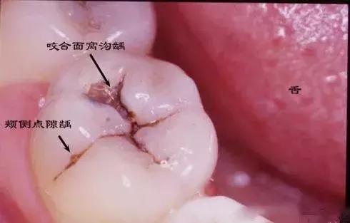 后牙上的黑线是蛀牙吗 该如何预防 知乎 后牙上的黑线是蛀牙吗 该如何预防 知乎