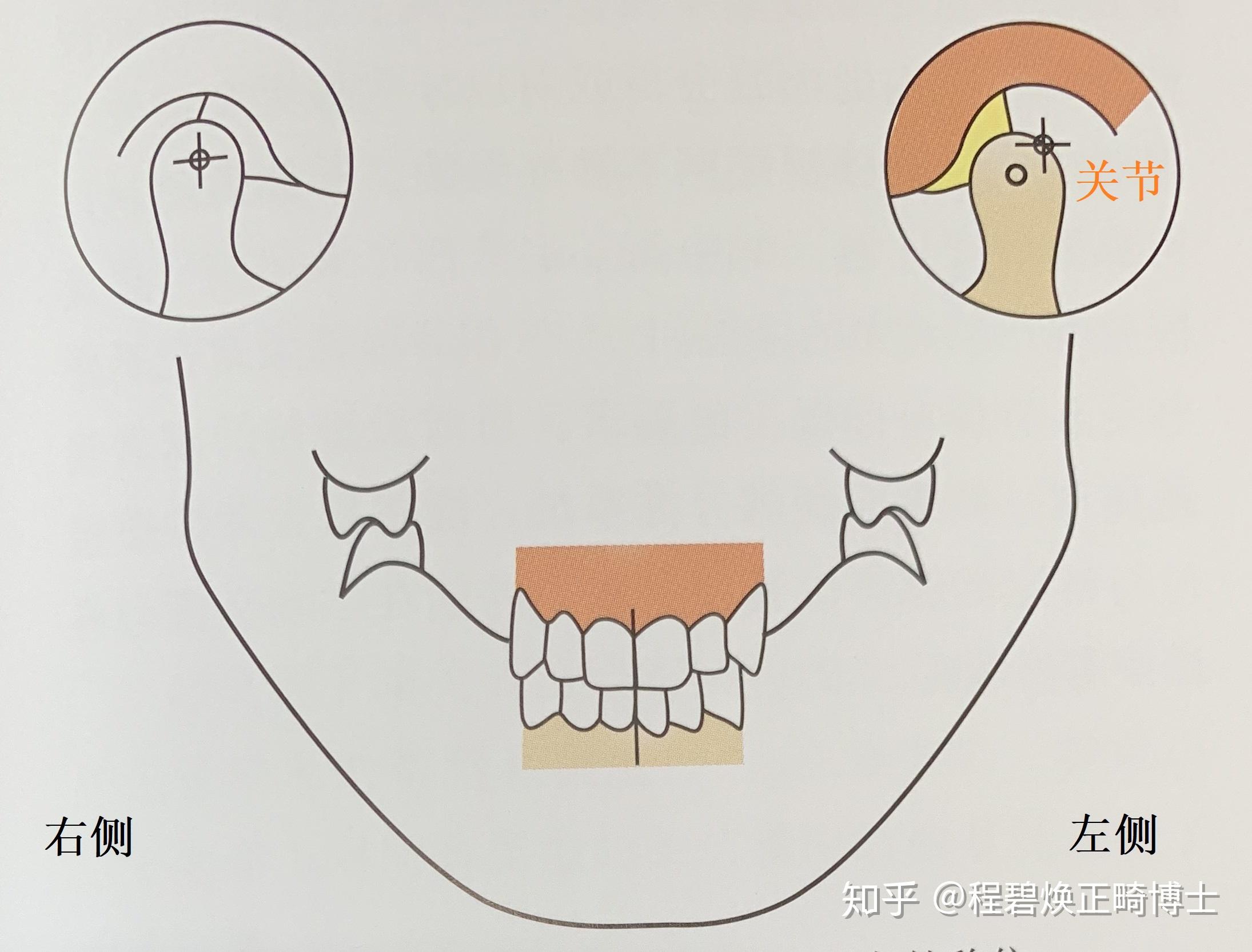 比如有了左側上頜尖牙,下頜向左側的側向運動可以保障在一個安全範圍