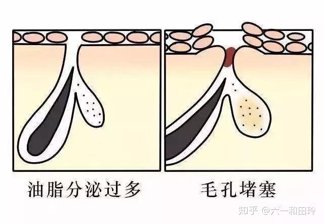 刷酸到底安全吗刷完这些反应正常吗在家刷酸可以吗刷酸的8条解析