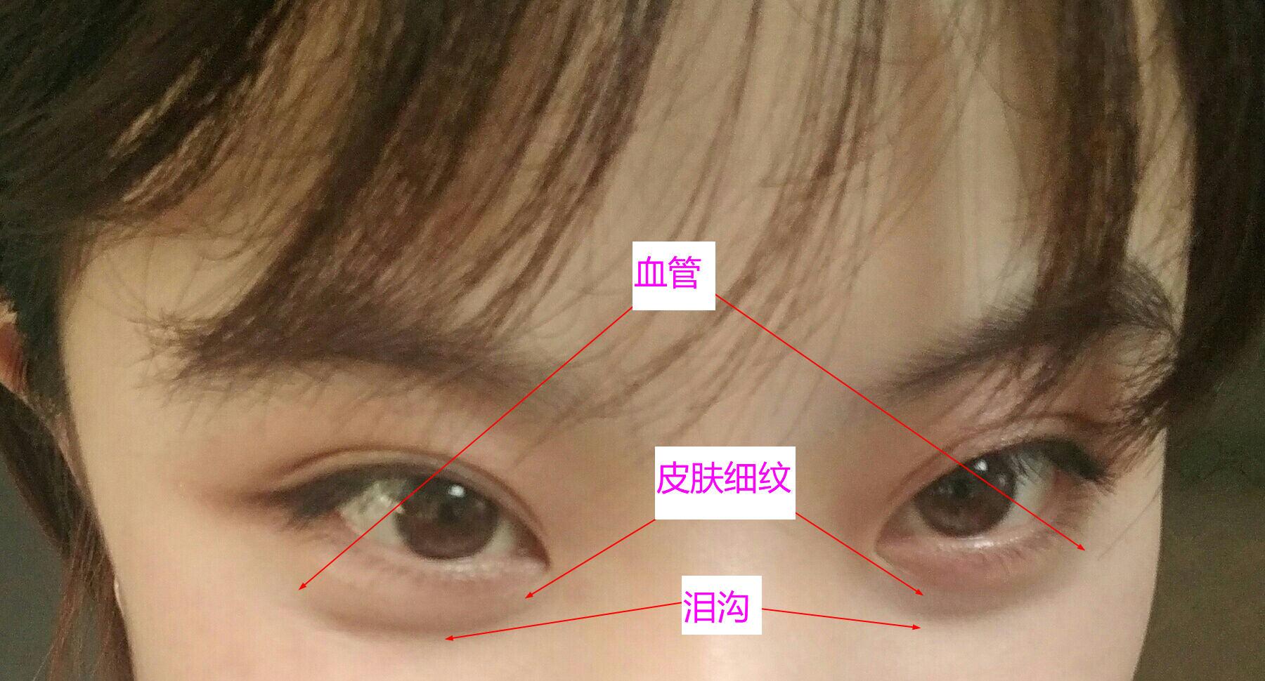 黑眼圈,眼皮薄怎么办?