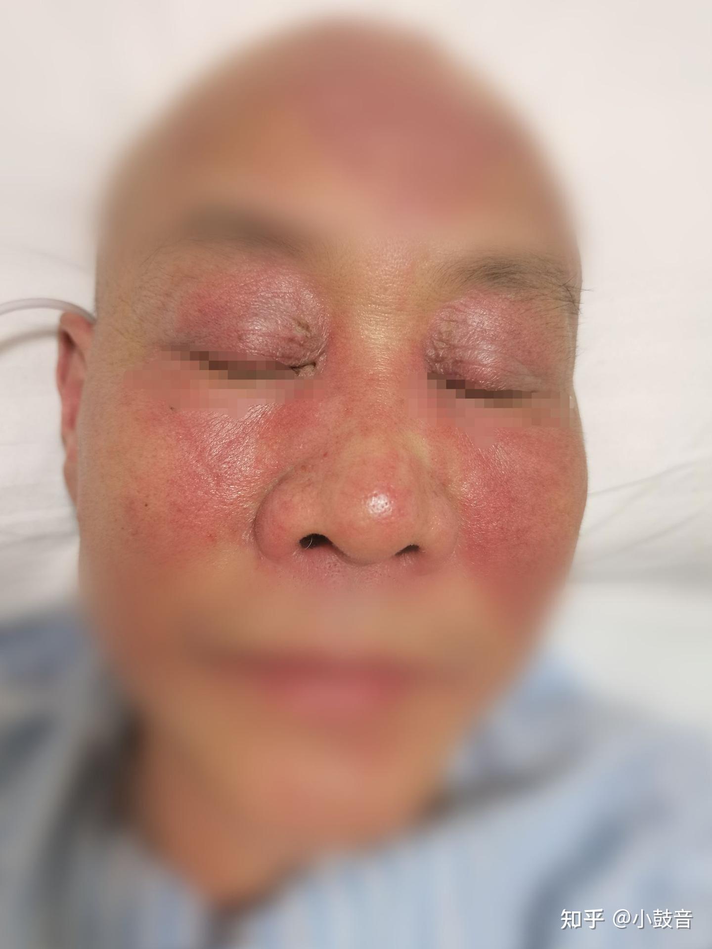 皮肌炎典型皮疹 - 知乎