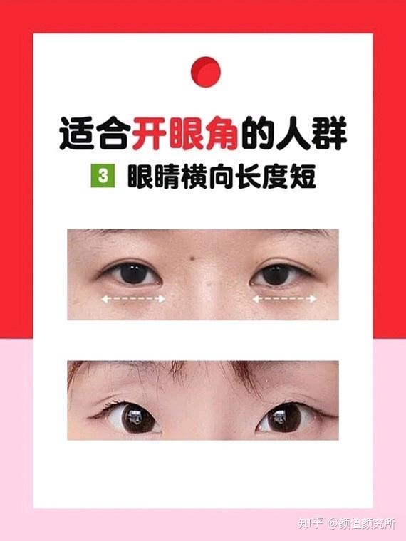 什么样的眼睛要开眼角开哪种眼角