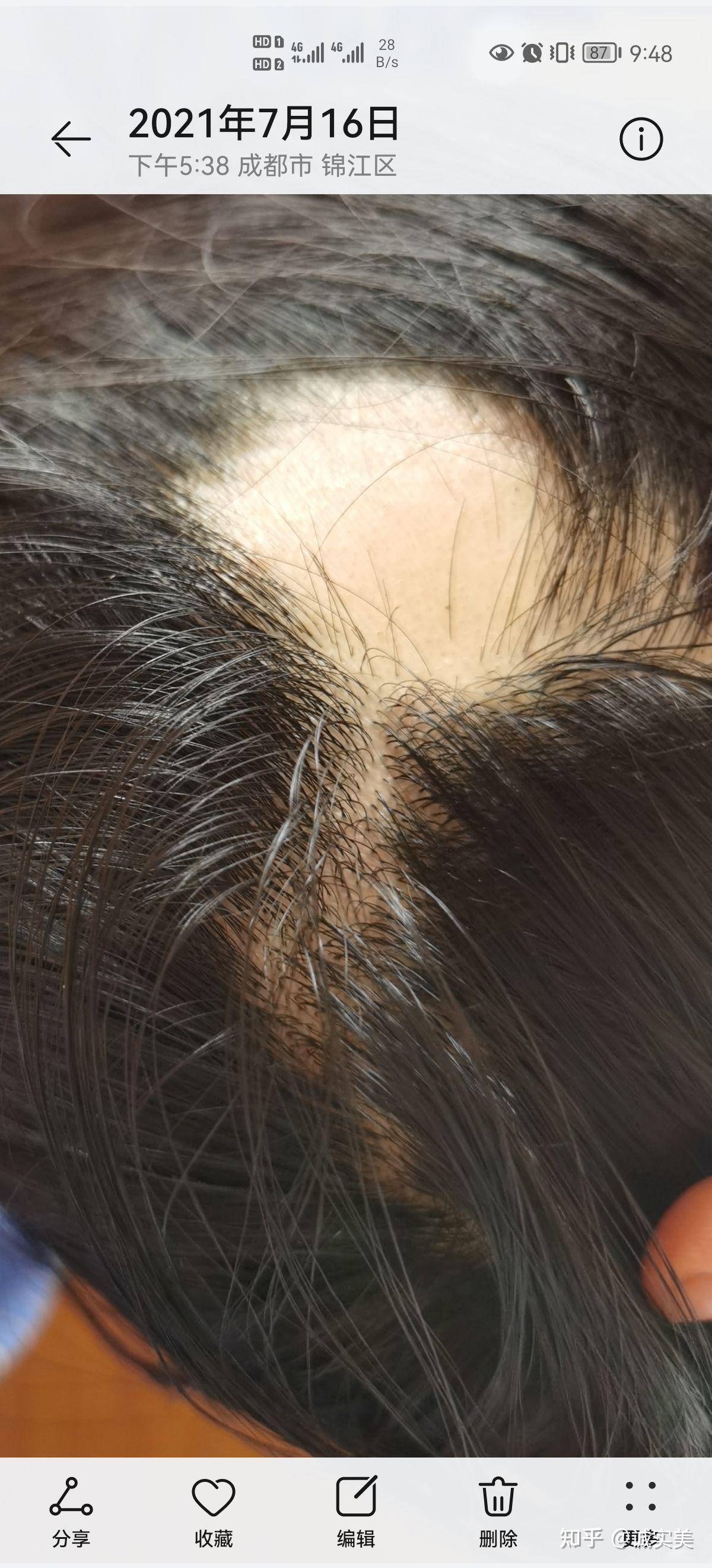 脂溢性脱发77斑秃,使用米诺地尔酊六个月变化!