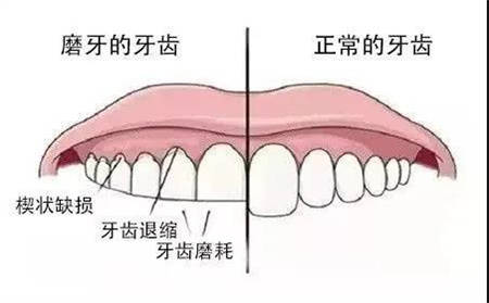 两颗大门牙有点龅牙怎么办？只矫正两颗门牙可以吗 - 知乎