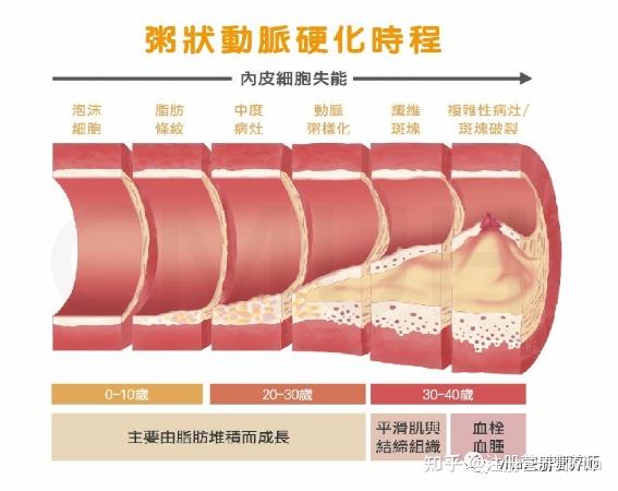 重新认识-动脉粥样硬化 - 知乎