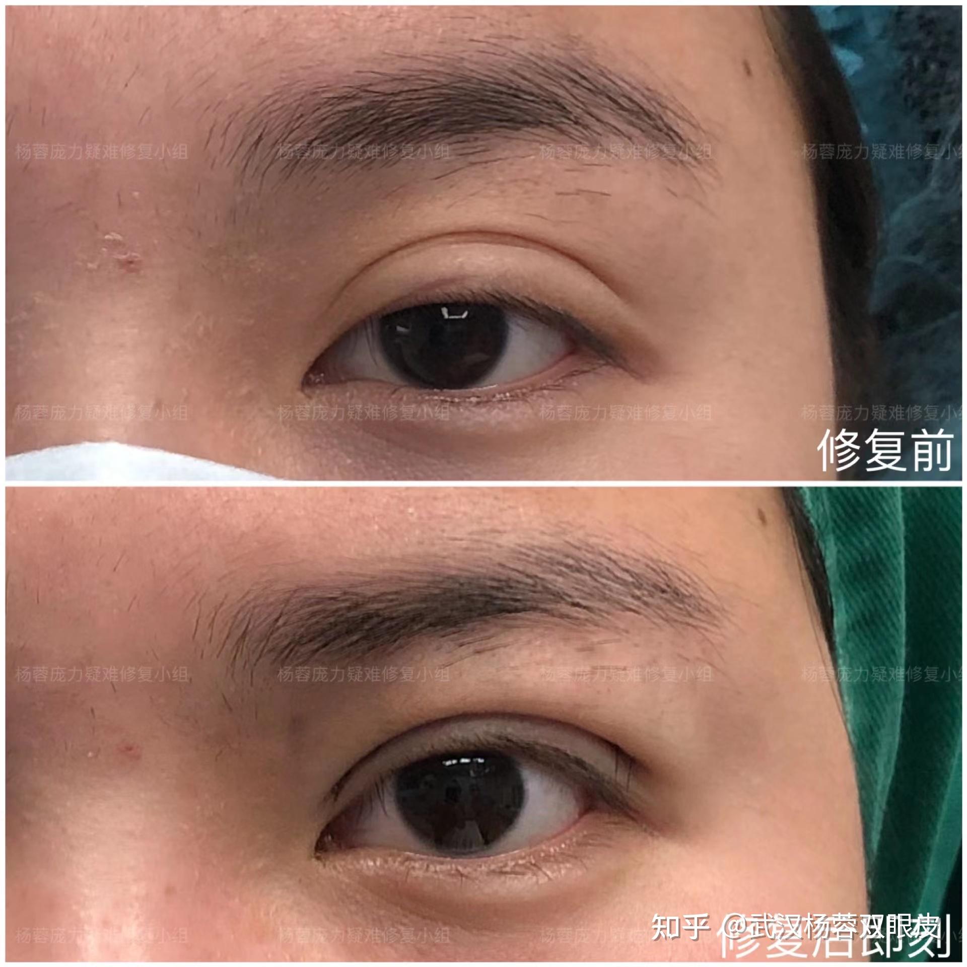 【全切双眼皮宽改窄】1公分的"肉条眼"双眼皮修复降至6.