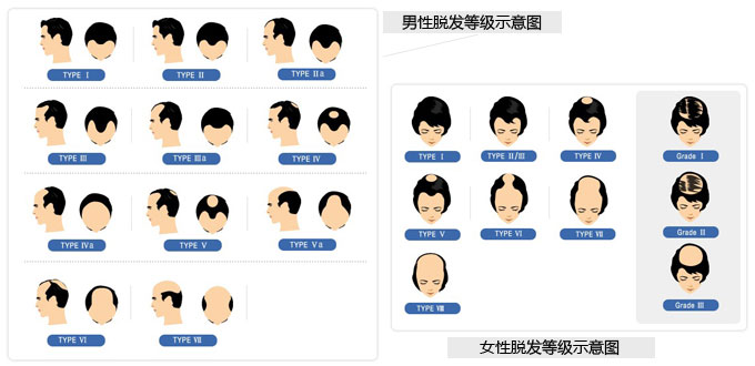 男性脱发主要分为7个级别