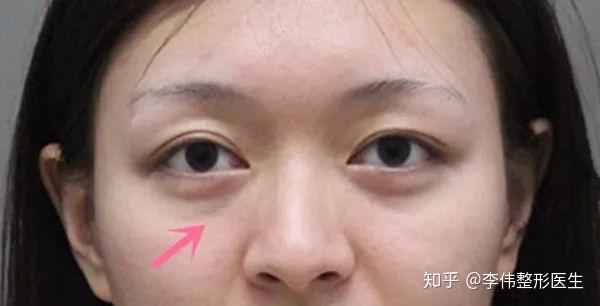 你的眼下其实不是卧蚕是泪沟和眼袋